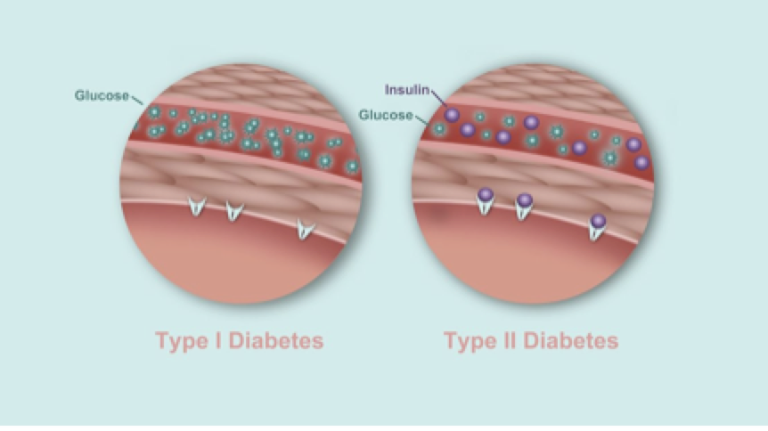 1型糖尿病和2型糖尿病有什么區別