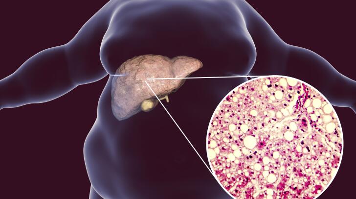 非酒精性脂肪肝